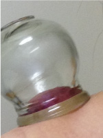 カッピング施術例