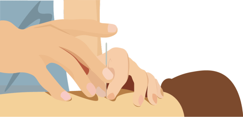 鍼灸施術の様子