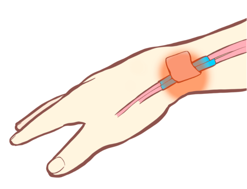 腱鞘炎の原因となる部位