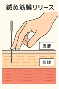 鍼灸筋膜リリースを示す解説図