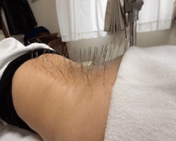 鬼美容鍼 ルート治療 横浜 大倉山