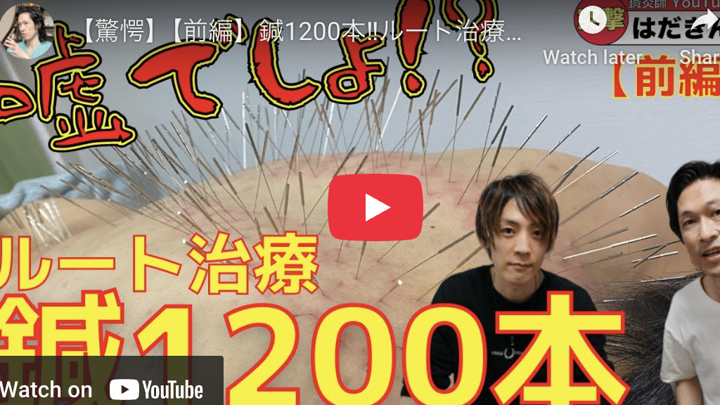 ルート治療を施術する様子｜ともこ鍼灸治療院（大倉山）